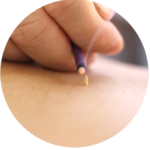 Moxibustion Benefits in EMW