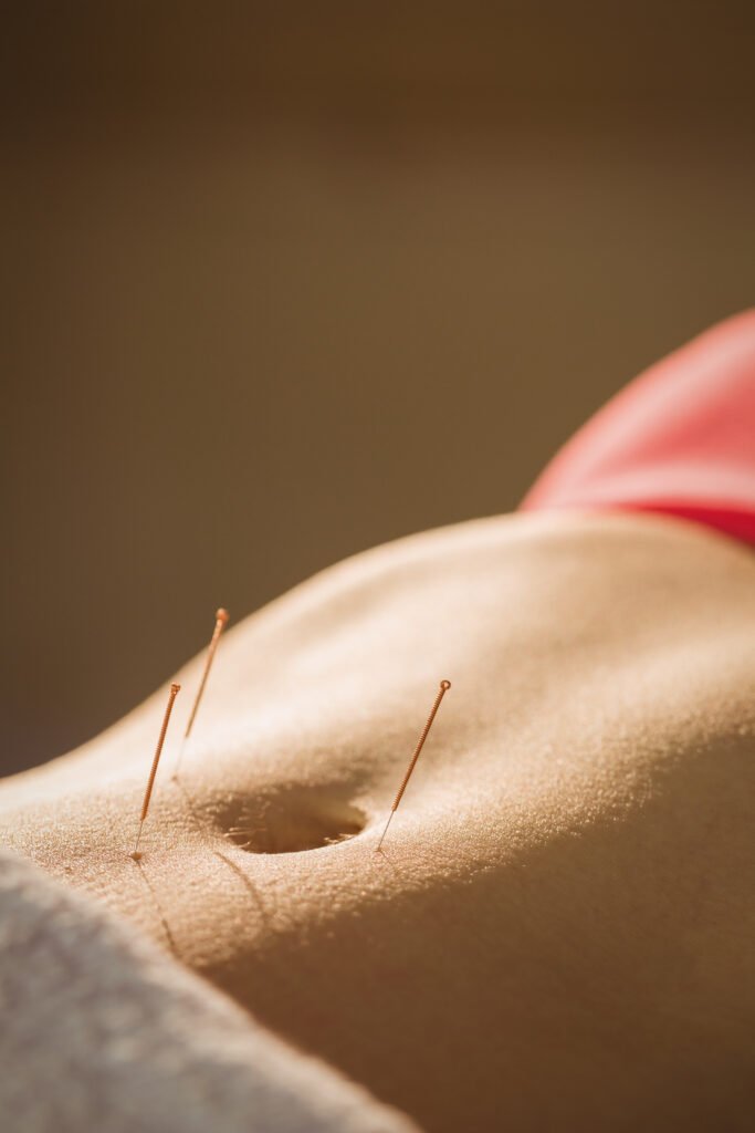 Young woman getting acupuncture treatment in therapy room
